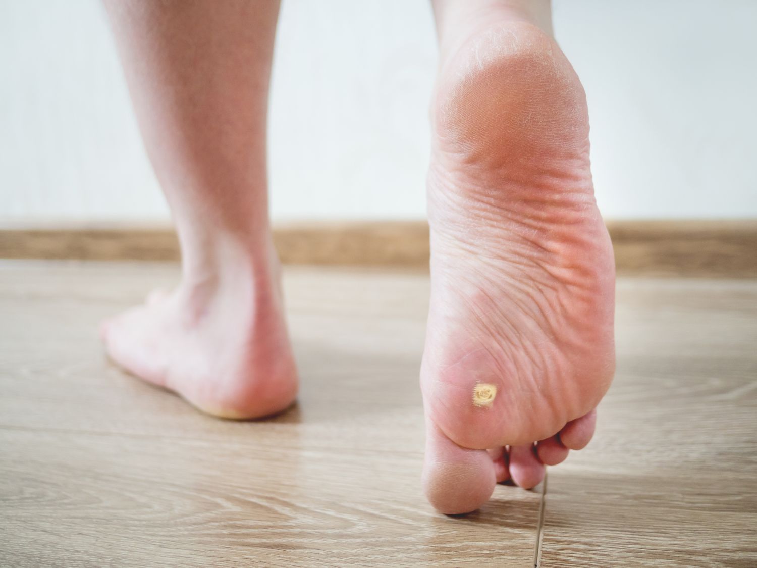 Plantar Wart Treatments: Remedies, Removal, and Care
