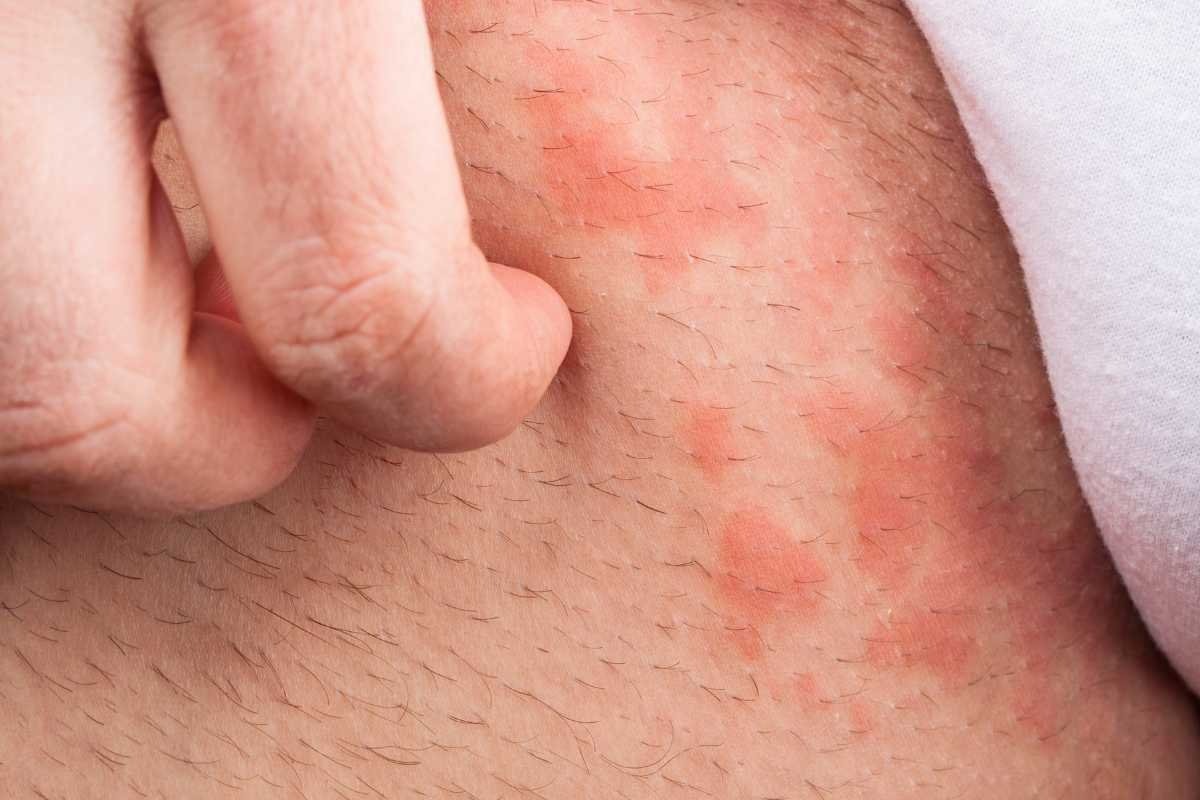 1-rashes-in-groin-area_-causes-s-1