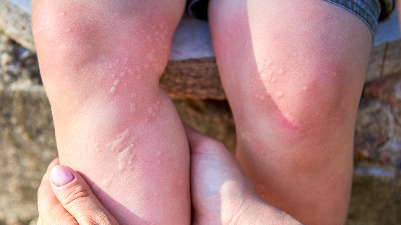 Breaking Out in Hives for No Apparent Reason