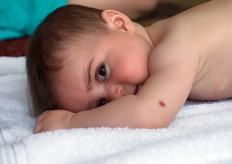 Baby Birthmarks: Types and Causes | Pampers UK