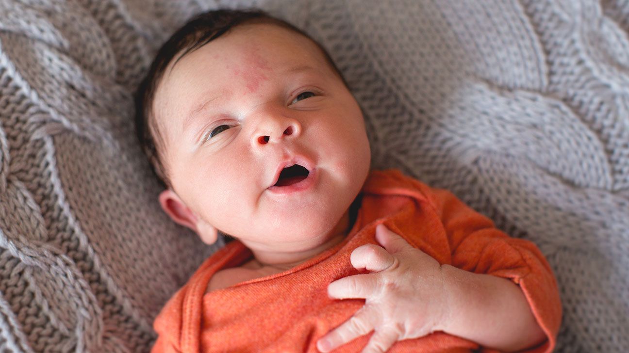 Stork bite: Pictures, causes, effects, and more