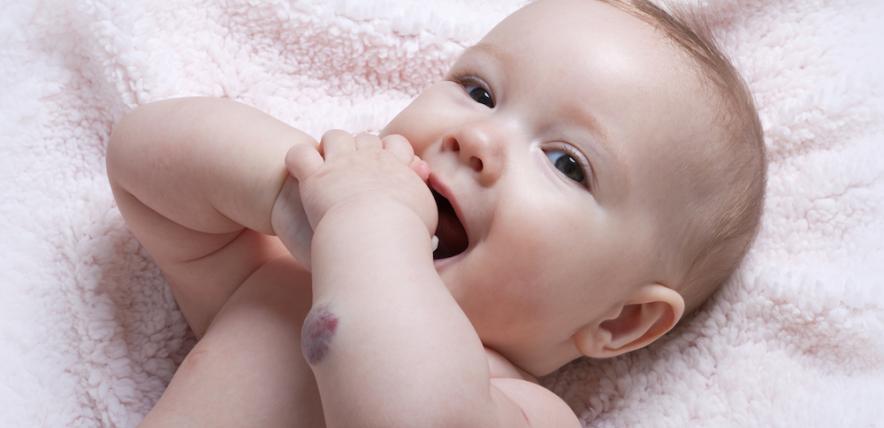 Are birthmarks dangerous? | Family Corner