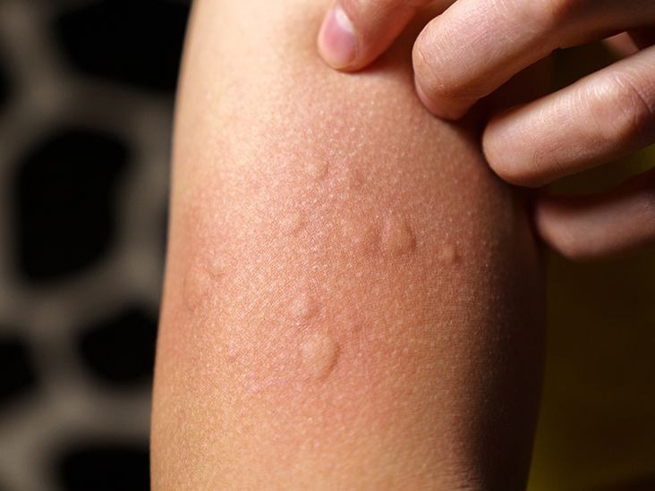 close-up-allergy-rash-hives-hand-1
