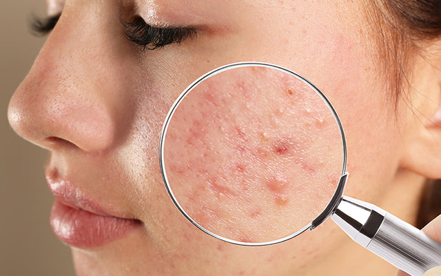 7 Remedies to Get Rid of Blind Pimples – Moraze Cosmetics