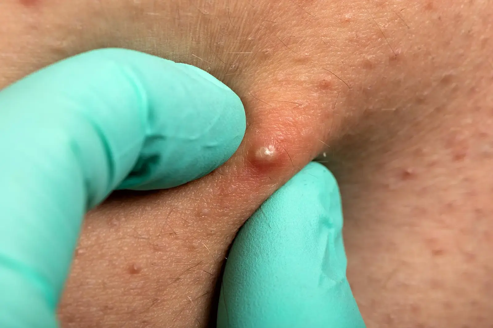 The Causes of Whiteheads - Key Insights You Need!