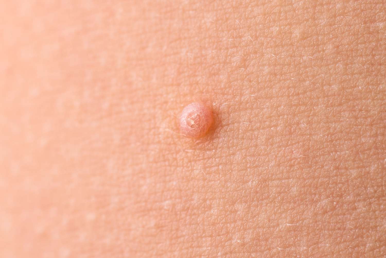 Nodules on Skin: Causes, Symptoms, and Treatment