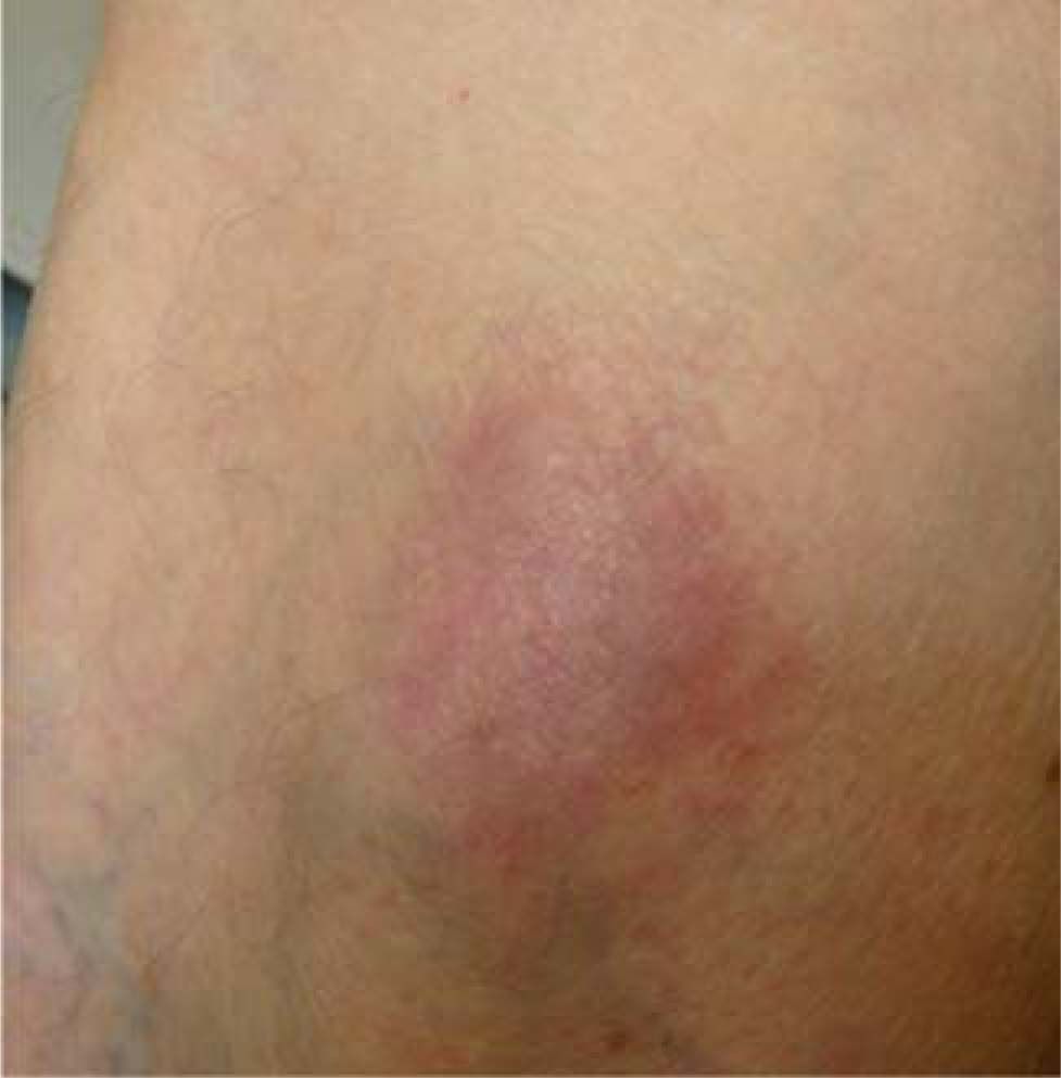 Skin manifestations of liver diseases | Annals of Hepatology