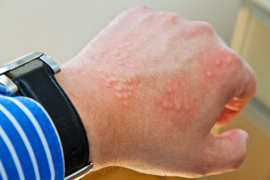 5 Causes of Hives You Wouldn't Expect - Geelong Medical & Health Group