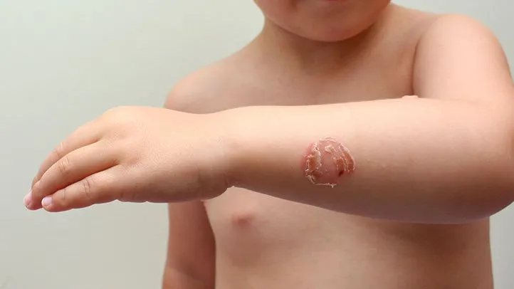 What Is Scabies? Symptoms, Causes, Diagnosis, Treatment, and Prevention