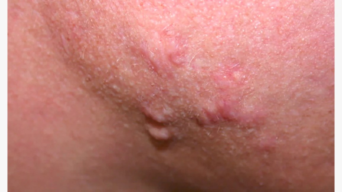 Raised Skin Bumps: Pictures, Types, Causes, and Treatment