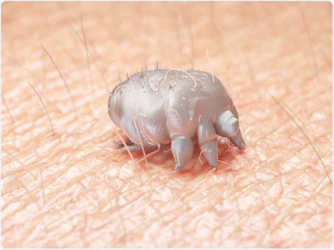 Scabies Symptoms