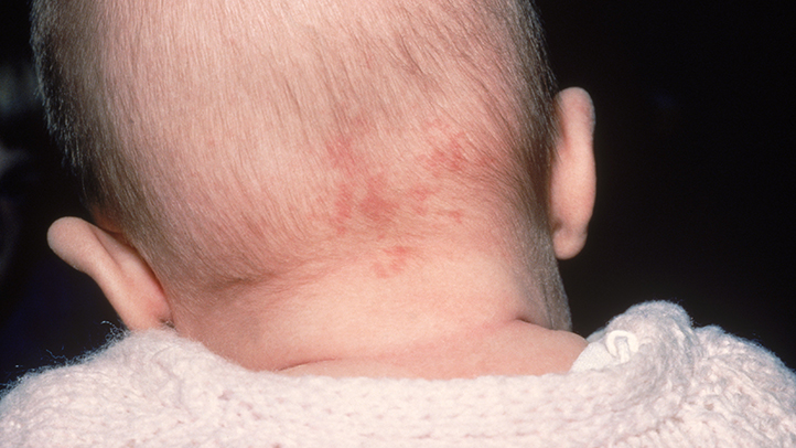 Stork Bite (Nevus Simplex) Birthmark: Angel's Kiss Birthmark Symptoms &  Causes