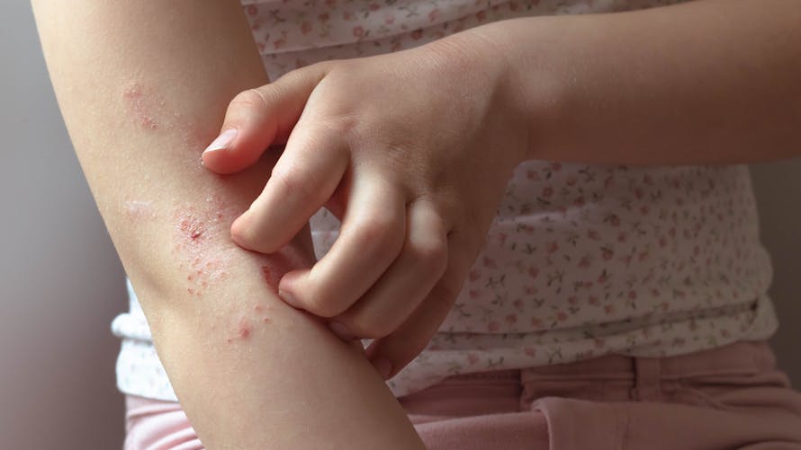 Impétigo chez l'enfant : symptômes, diagnostic, traitements | Parents.fr